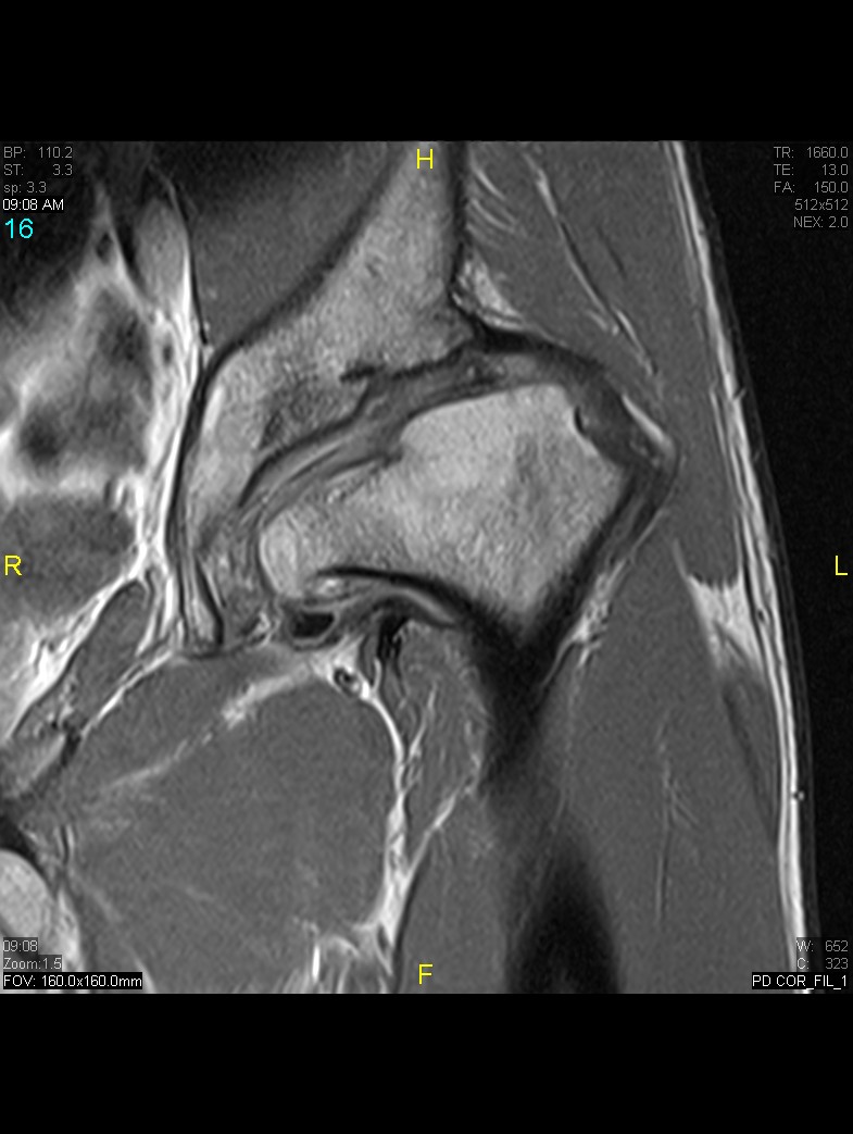 Figure 7 for case History Perthes Disease